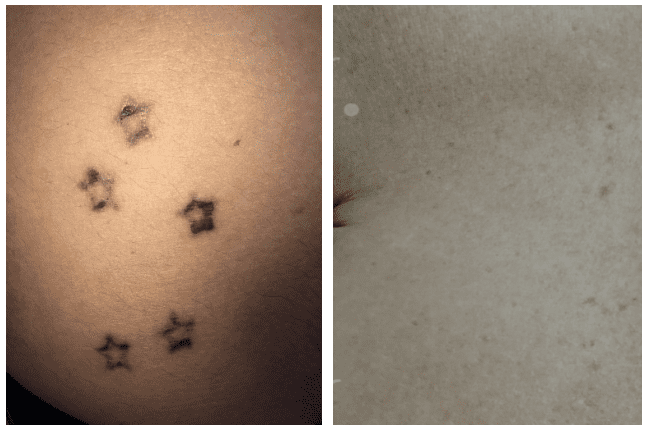 Efectos secundarios de borrar tatuaje con laser