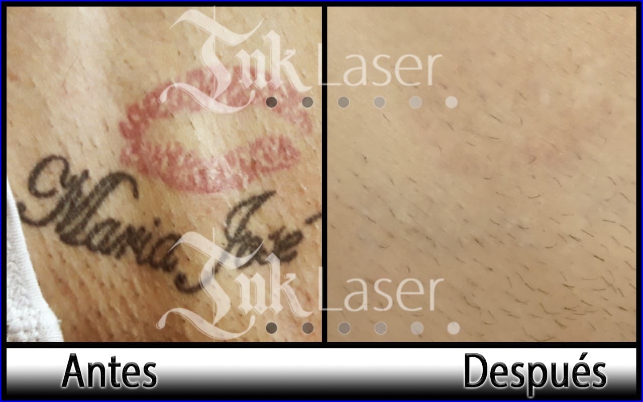 Resultado de quitar tatuajes con láser