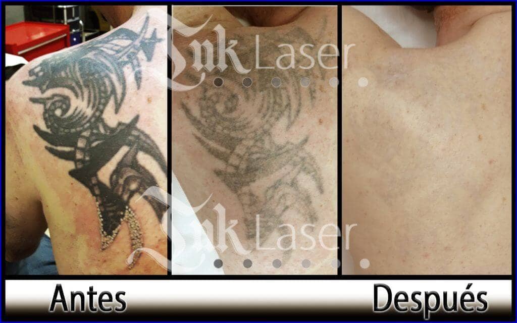 Resultado de borrar tatuajes con láser