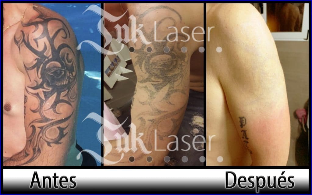 Tatuaje borrado con láser antes y después
