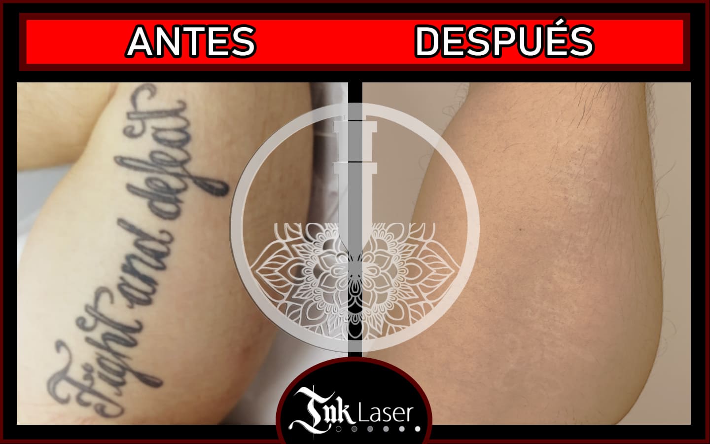 Eliminar Tatuajes Alicante