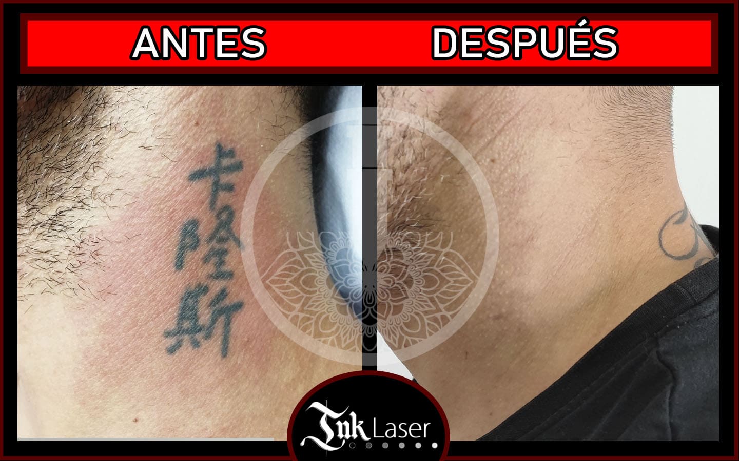 Resultados de tatuajes borrados con láser antes y después.