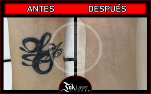 Lasser tattoo Alicante