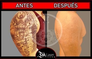 Ofertas de eliminar tatuajes con láser
