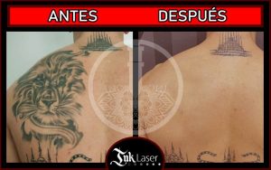 Quitar tatuajes con láser antes y después