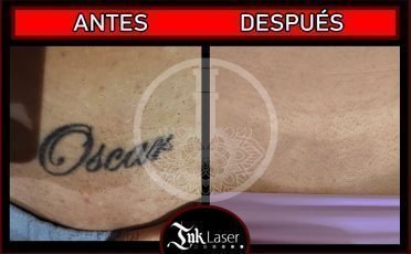 Borrar tatuajes Alicante
